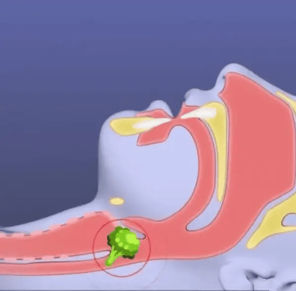AirwayClear anti-choking device ensuring effective airway clear solutions for emergency respiratory aid
